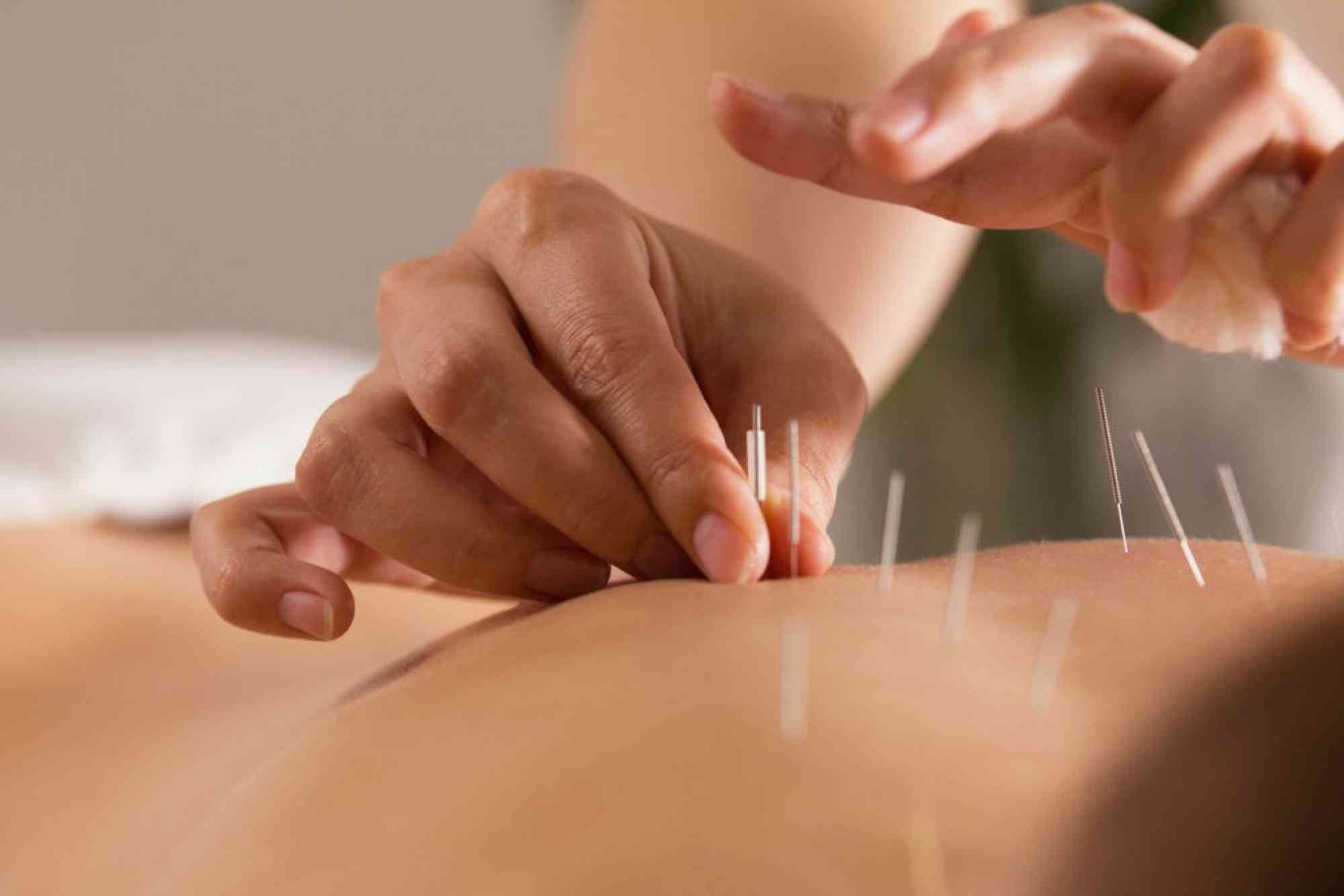 Acupuncture